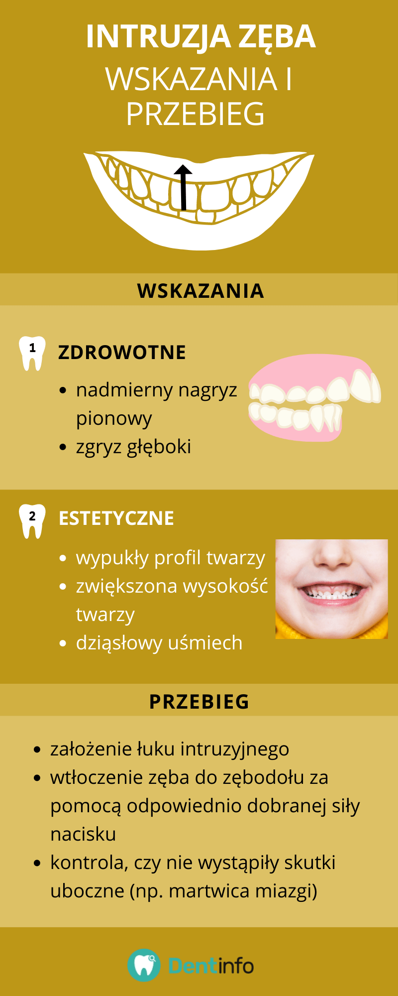 Intruzja zęba – wskazania i przebieg
Wskazania:
1. Zdrowotne
- nadmierny nagryz pionowy
- zgryz głęboki
2. Estetyczne
- wypukły profil twarzy
- zwiększona wysokość twarzy
- dziąsłowy uśmiech
Przebieg:
- założenie łuku intruzyjnego
- wtłoczenie zęba do zębodołu za pomocą odpowiednio dobranej siły nacisku
- kontrola, czy nie wystąpiły skutki uboczne (np. martwica miazgi)