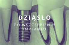 dziąsło po wszczepieniu implantu