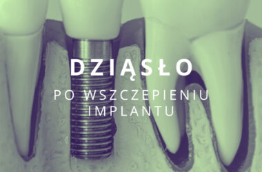 dziąsło po wszczepieniu implantu