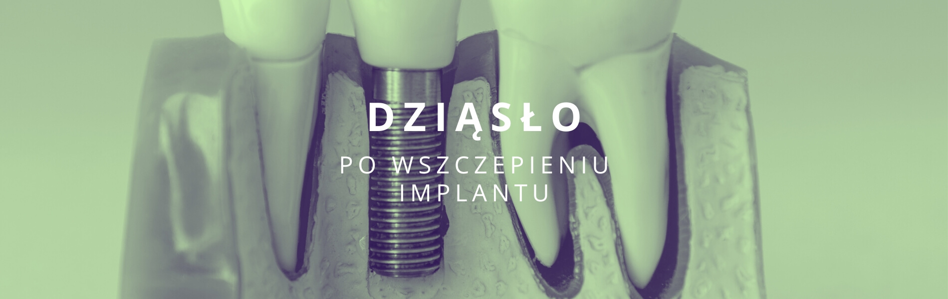 dziąsło po wszczepieniu implantu