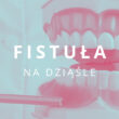 fistuła