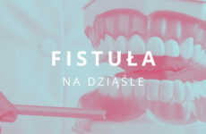 fistuła