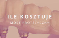 ile kosztuje most protetyczny