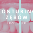 konturing zębów przed i po