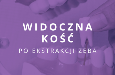 po wyrwaniu zęba widać kość