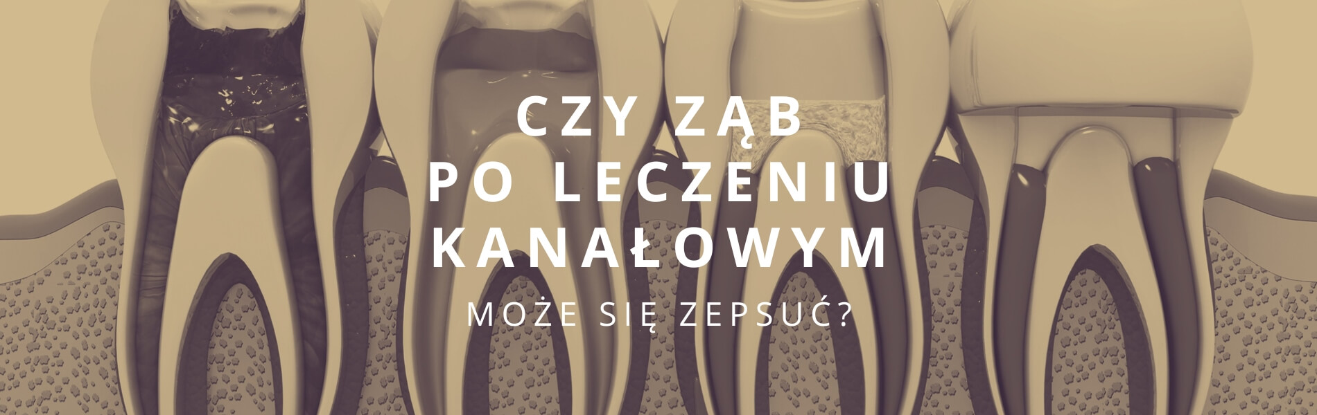 czy ząb po leczeniu kanałowym może się zepsuć