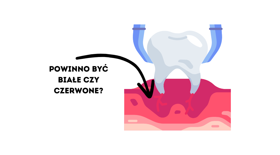 jaki kolor powinno mieć dziąsło po wyrwaniu zęba