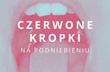 czerwone kropki na podniebieniu