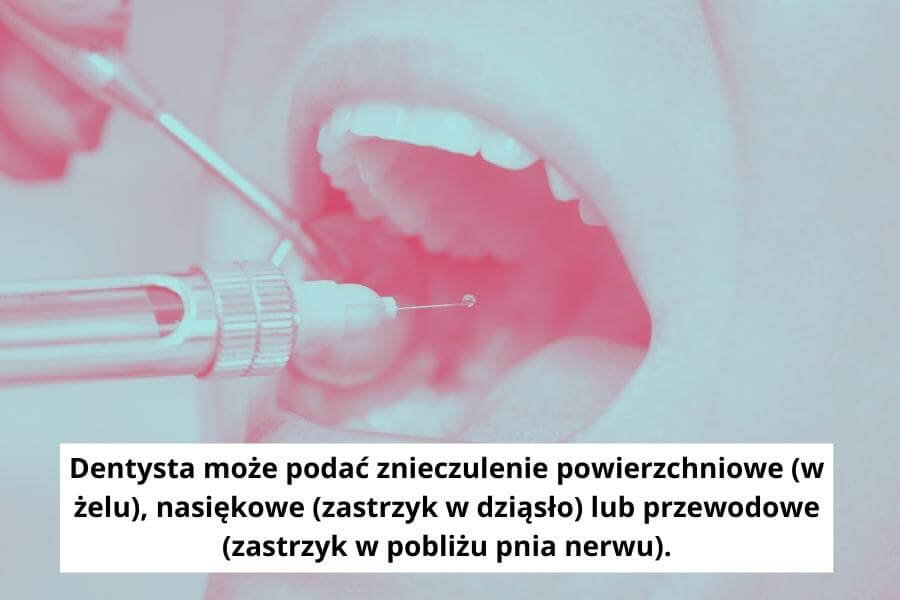 Dentysta może podać znieczulenie powierzchniowe (w żelu), nasiękowe (zastrzyk w dziąsło) lub przewodowe (zastrzyk w pobliżu pnia nerwu).