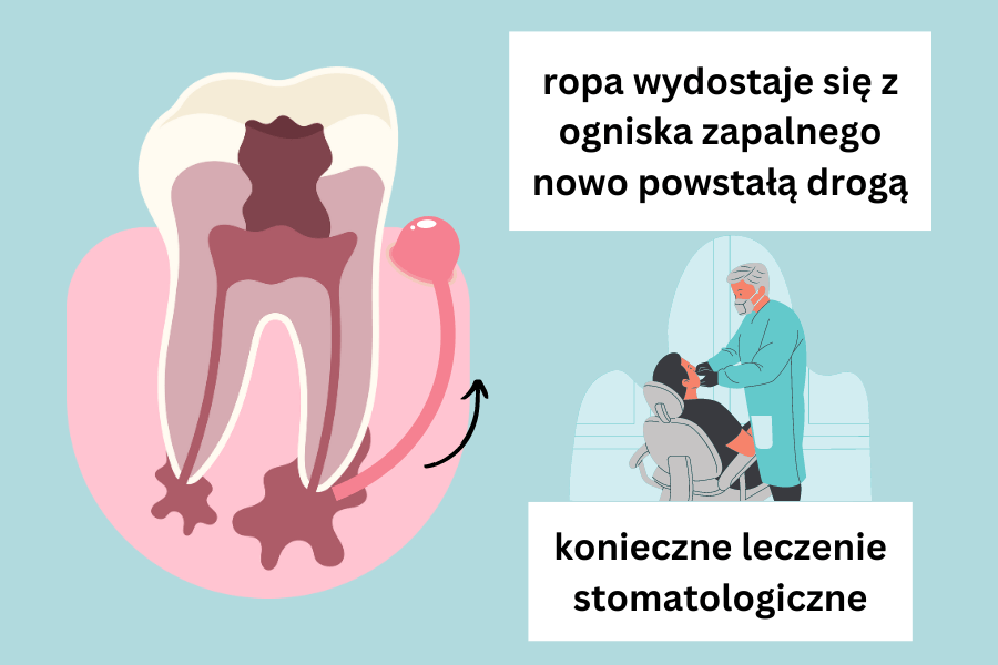 ropa wydostaje się z ogniska zapalnego nowo powstałą drogą; konieczne leczenie stomatologiczne