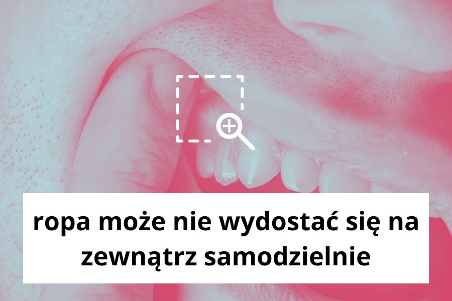 ropa może nie wydostać się na zewnątrz samodzielnie