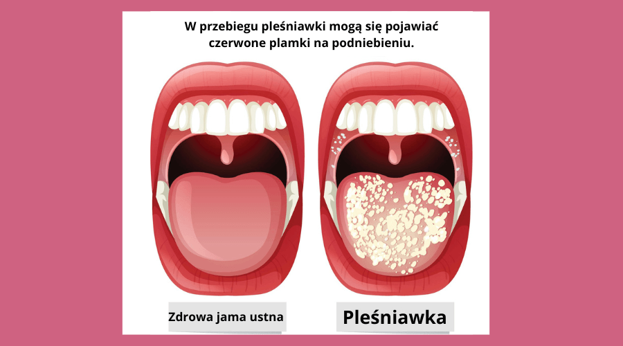 W przebiegu pleśniawki mogą się pojawiać czerwone plamki na podniebieniu.