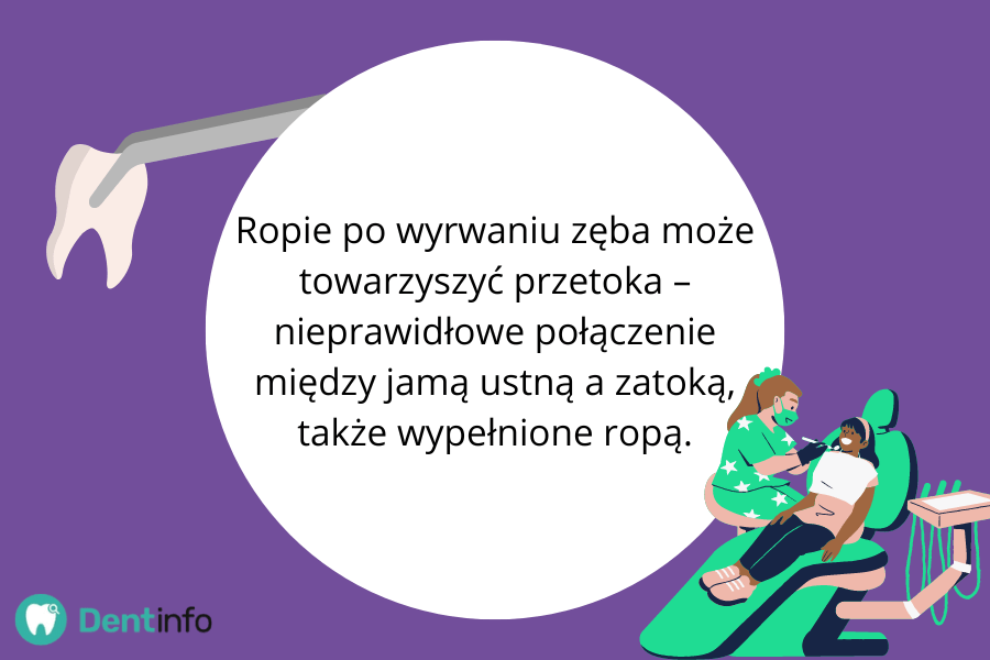 Ropie po wyrwaniu zęba może towarzyszyć przetoka – nieprawidłowe połączenie między jamą ustną a zatoką, także wypełnione ropą.