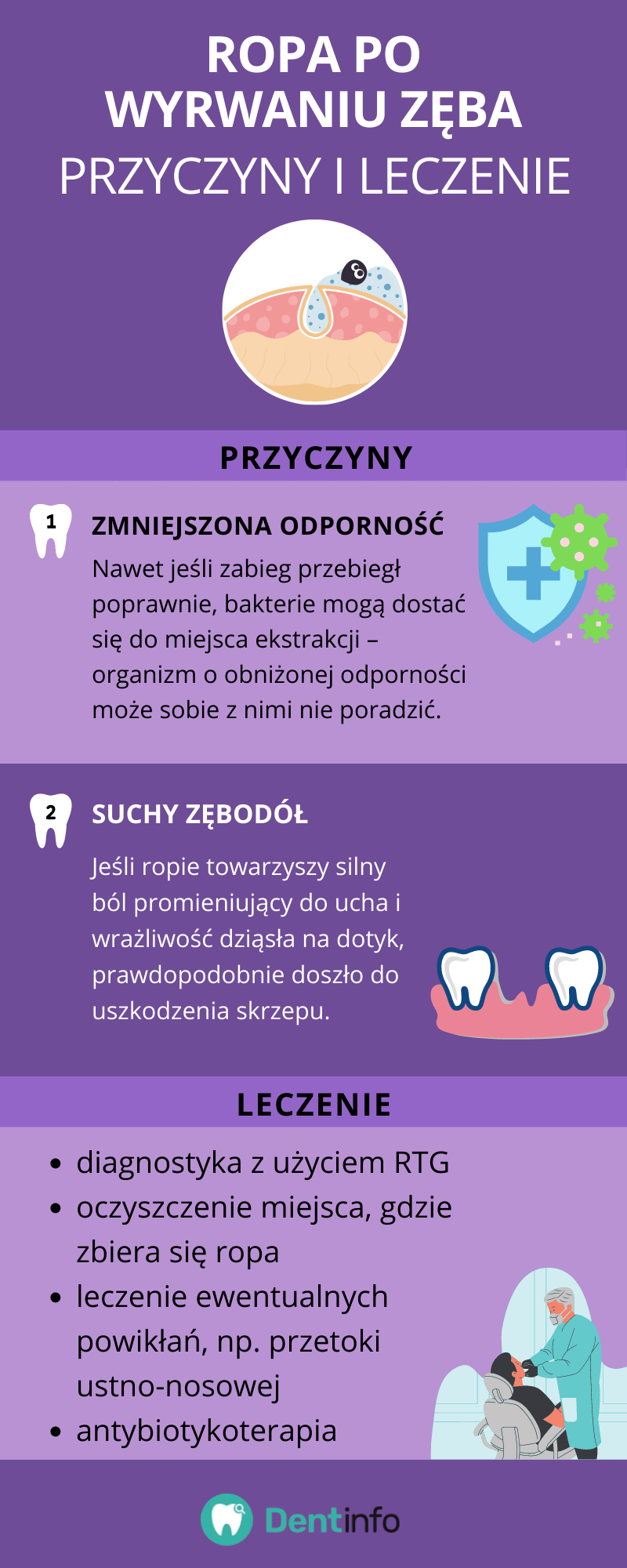 Ropa po wyrwaniu zęba – przyczyny i leczenie
Przyczyny:
1. Zmniejszona odporność – Nawet jeśli zabieg przebiegł poprawnie, bakterie mogą dostać się do miejsca ekstrakcji – organizm o obniżonej odporności może sobie z nimi nie poradzić.
2. Suchy zębodół – Jeśli ropie towarzyszy silny ból promieniujący do ucha i wrażliwość dziąsła na dotyk, prawdopodobnie doszło do uszkodzenia skrzepu.
Leczenie:
- diagnostyka z użyciem RTG
- oczyszczenie miejsca, gdzie zbiera się ropa
- leczenie ewentualnych powikłań, np. przetoki ustno-nosowej
- antybiotykoterapia