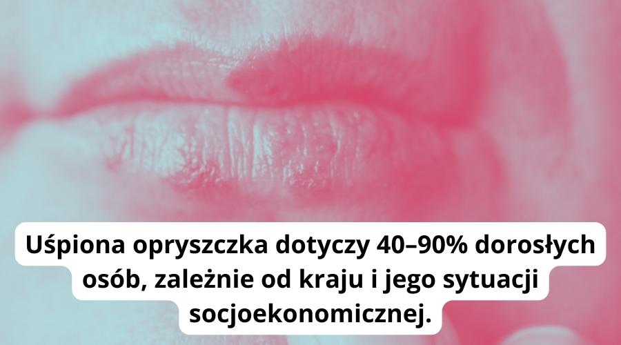 Uśpiona opryszczka dotyczy 40–90% dorosłych osób, zależnie od kraju i jego sytuacji socjoekonomicznej.