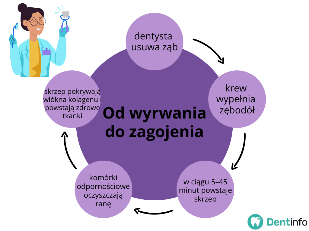 Od wyrwania do zagojenia:
- dentysta usuwa ząb
- krew wypełnia zębodół
- w ciągu 5–45 minut powstaje skrzep
- komórki odpornościowe oczyszczają ranę
- skrzep pokrywają włókna kolagenu i powstają zdrowe tkanki