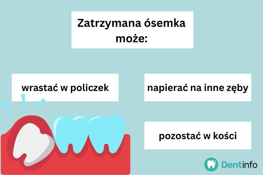 Zatrzymana ósemka może:
- wrastać w policzek
- napierać na inne zęby
- pozostać w kości.