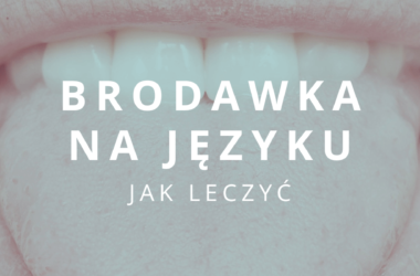 brodawka na języku