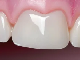 Białe zęby licówki