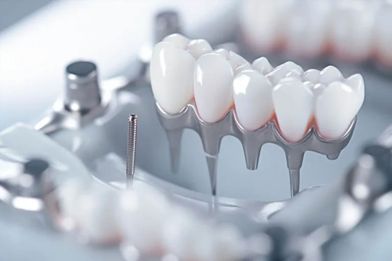 Mini implanty dentystyczne: innowacyjne rozwiązanie w stomatologii